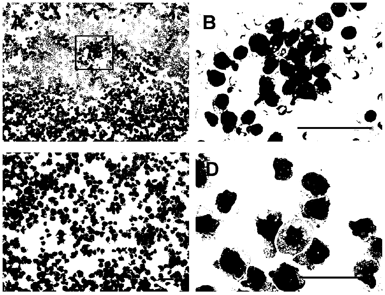 Highly aggressive human acute b lymphocytic leukemia cell line with add(11)(q23) chromosomal abnormality