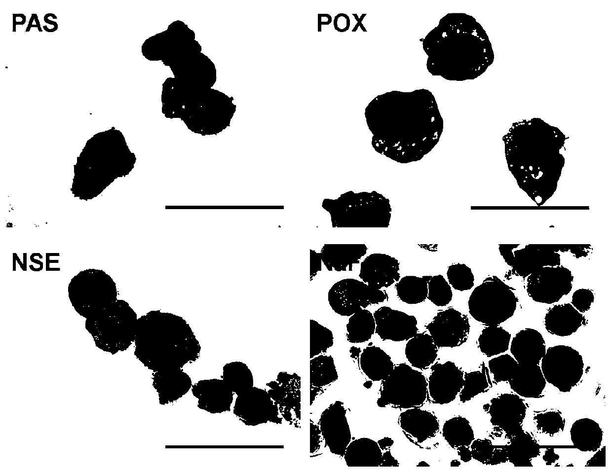 Highly aggressive human acute b lymphocytic leukemia cell line with add(11)(q23) chromosomal abnormality