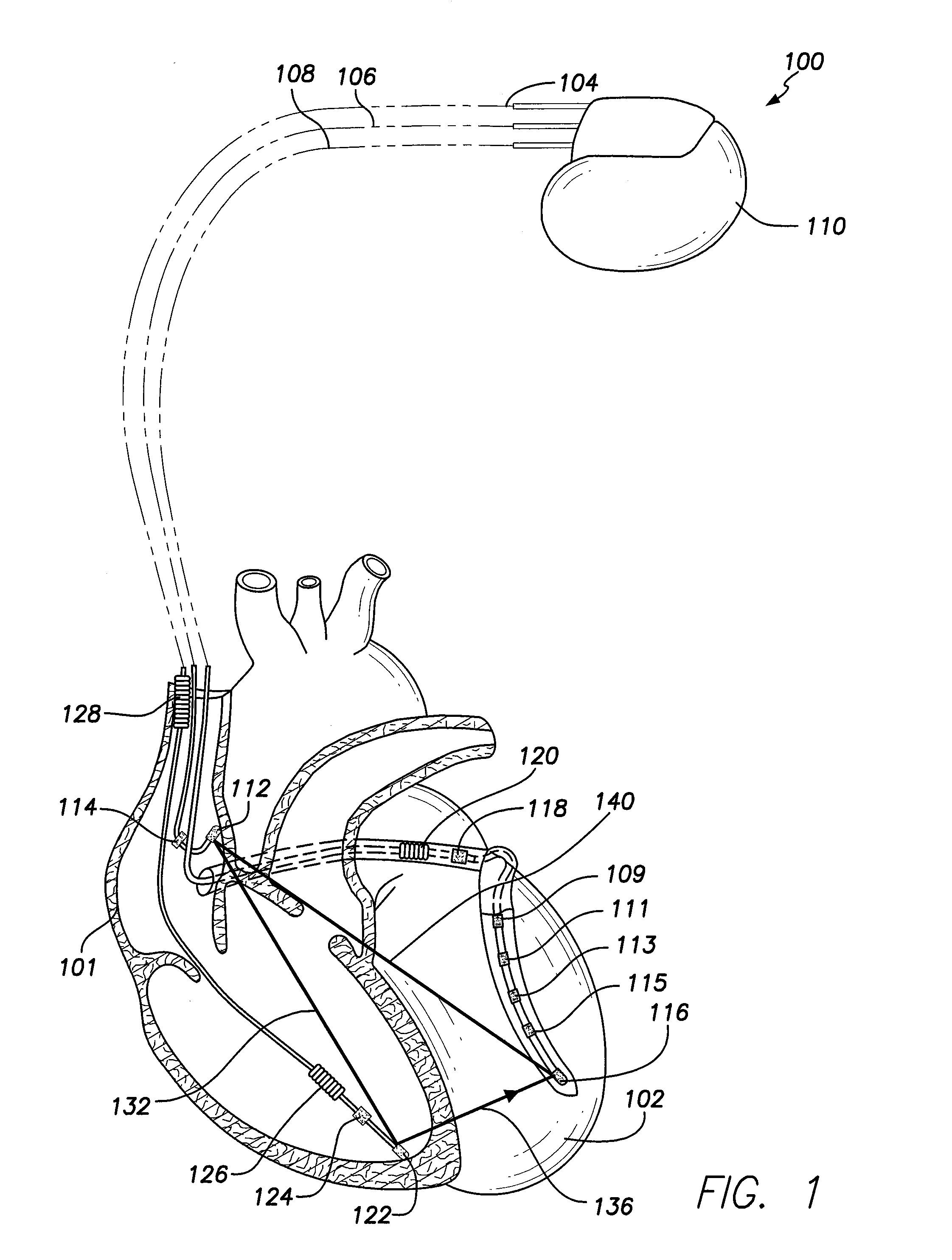 Methods and systems for determining pacing parameters based on repolarization index