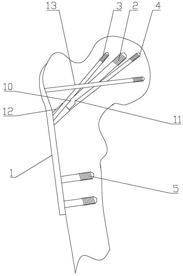 Three-fork type internal fixing device for treating femoral neck fracture