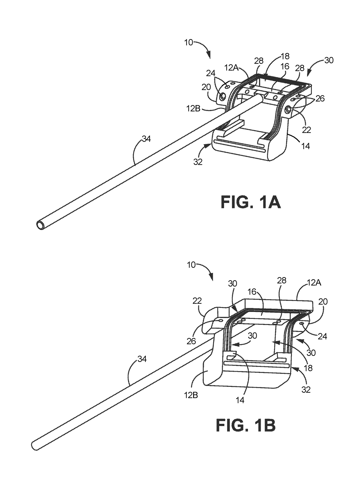 Adjustable allograft templates and methods of use