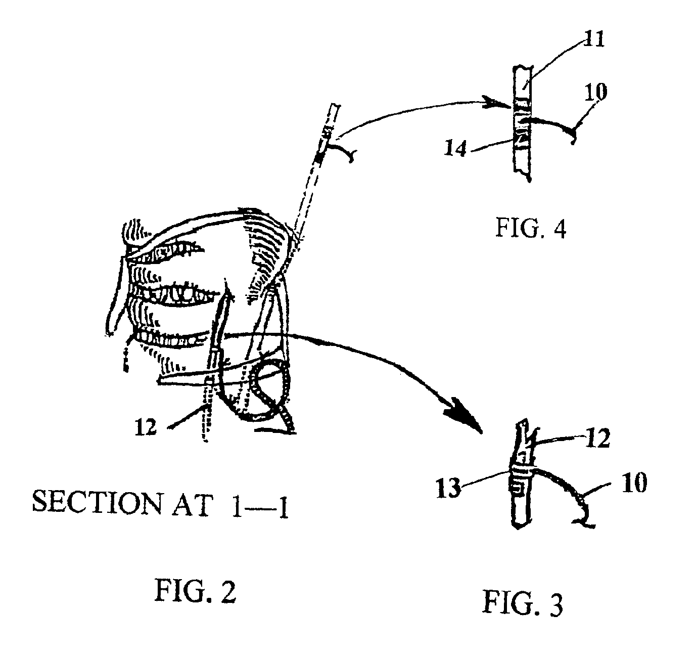 Method and system for dynamic vocal fold closure with neuro-electrical stimulation