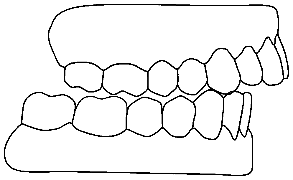 Preparation method of appliance for abnormality repositioning of mandible