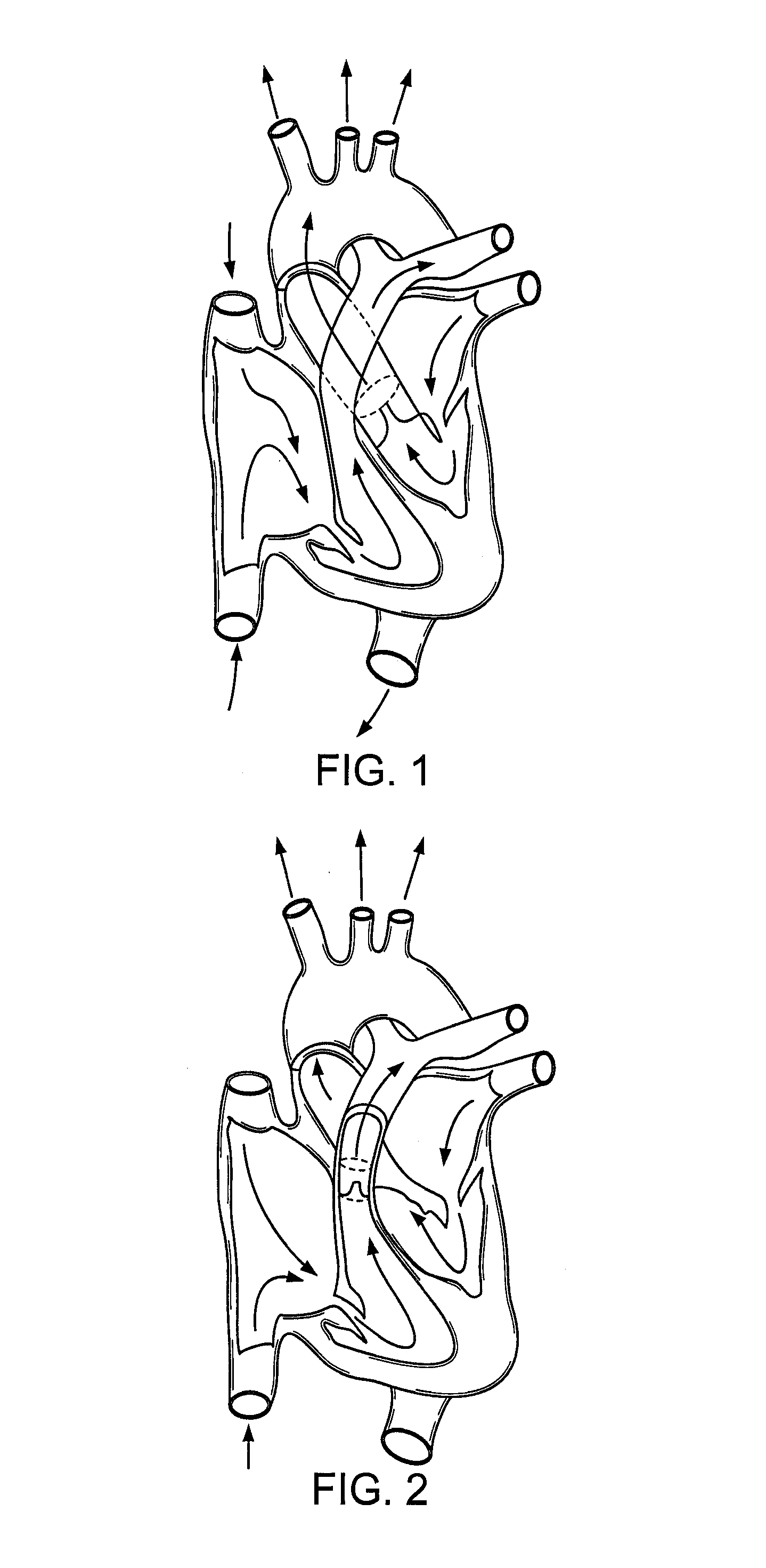 Involuted endovascular valve and method of construction