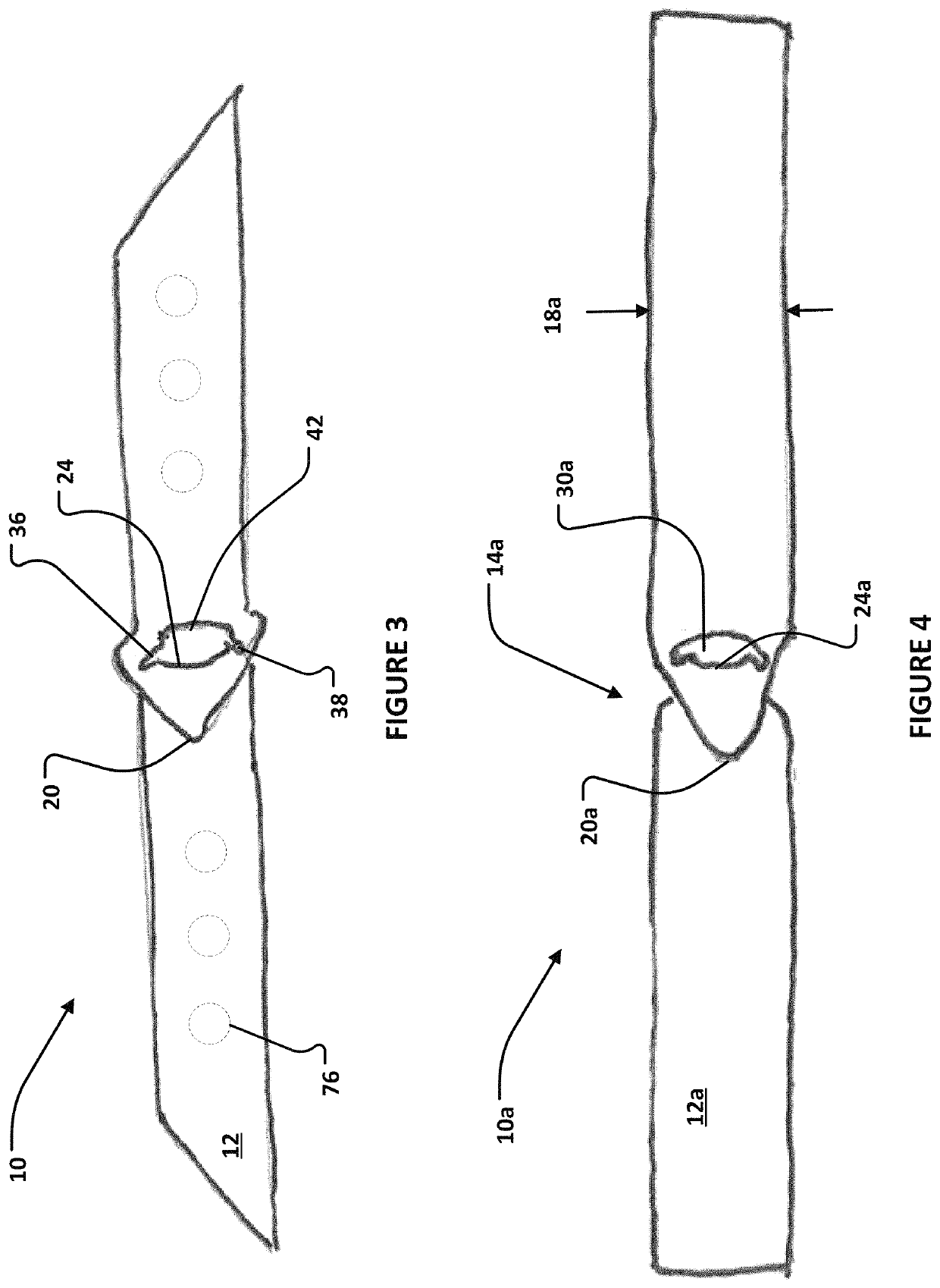 Corneal prosthesis and method of penetrating keratoplasty