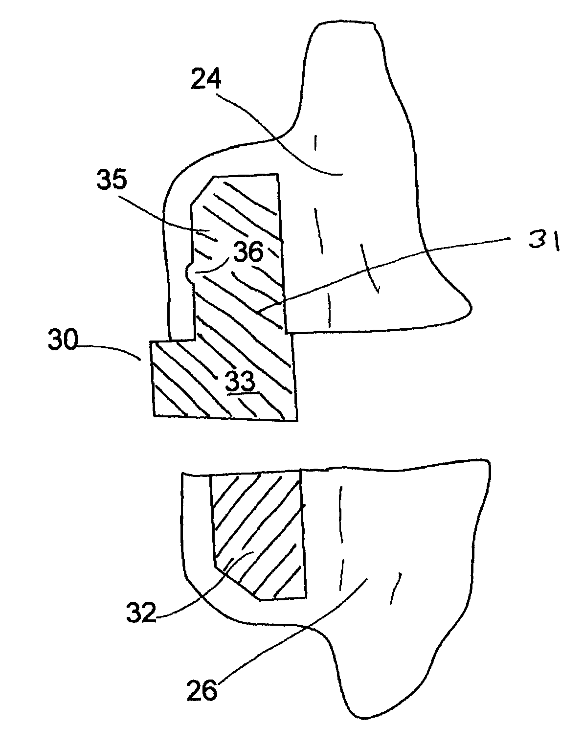 Methods of making and using an ankle-foot orthosis
