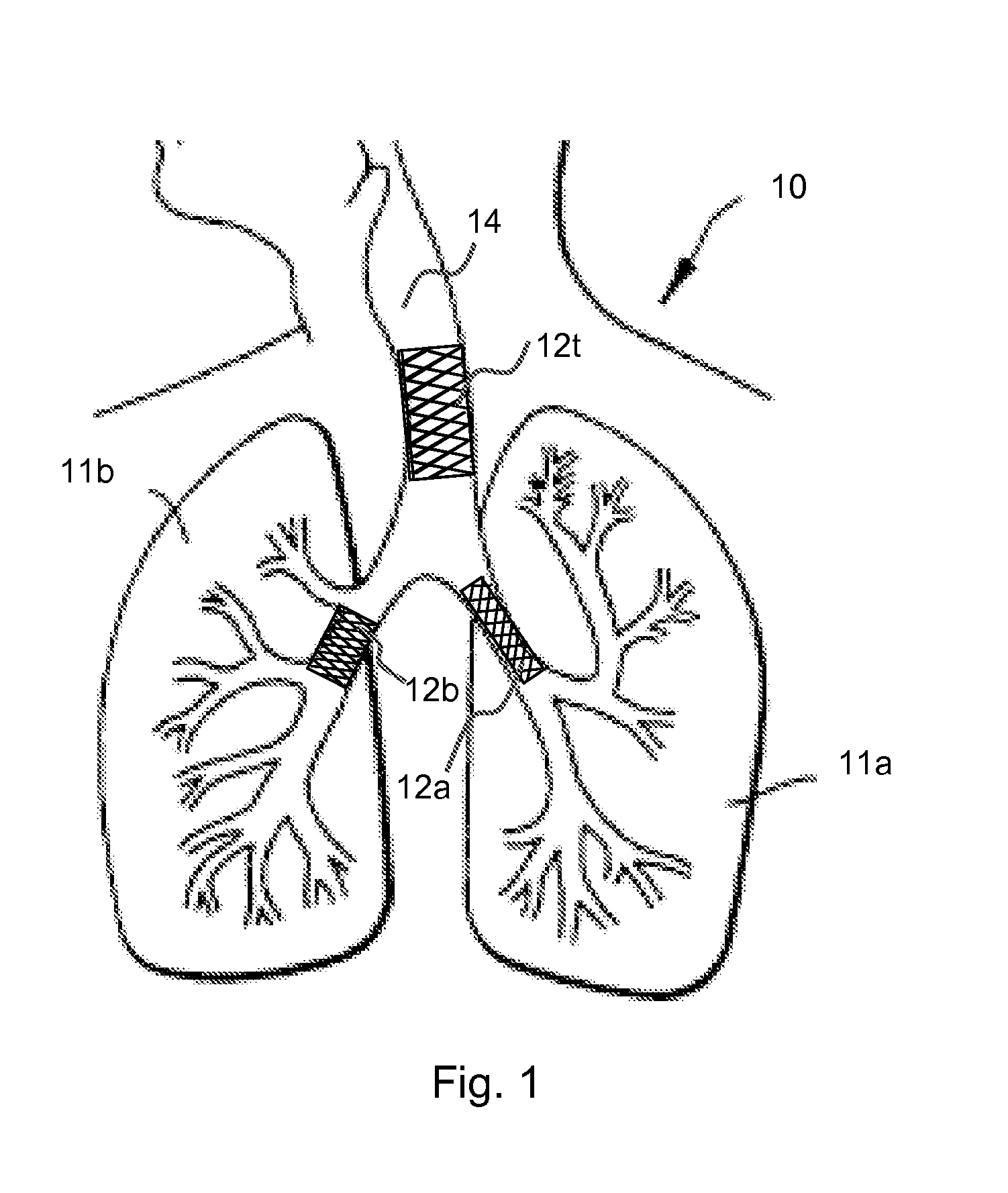 Therapeutic agent delivery for the treatment of asthma via implantable and insertable medical devices