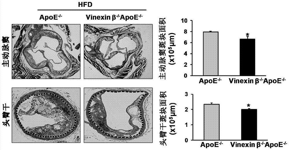 Function and application of Vinexin[beta] in treatment of atherosclerosis