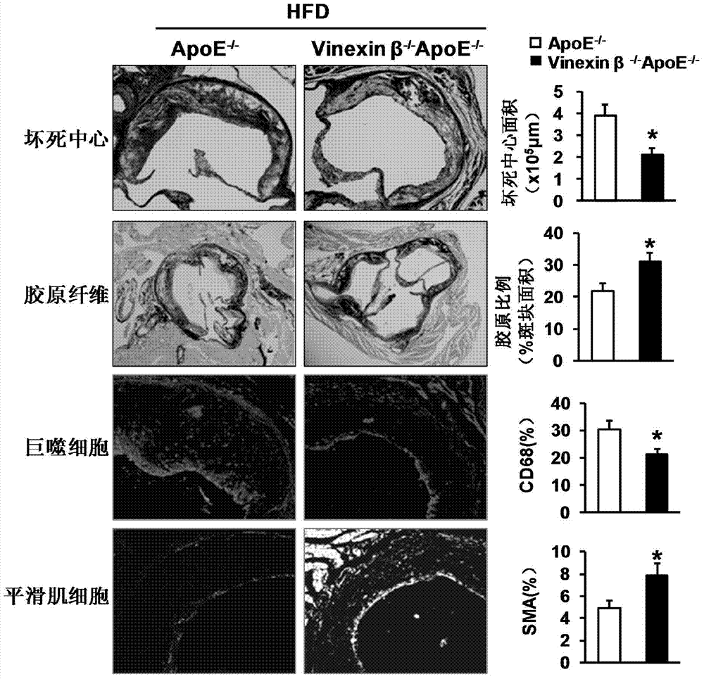 Function and application of Vinexin[beta] in treatment of atherosclerosis