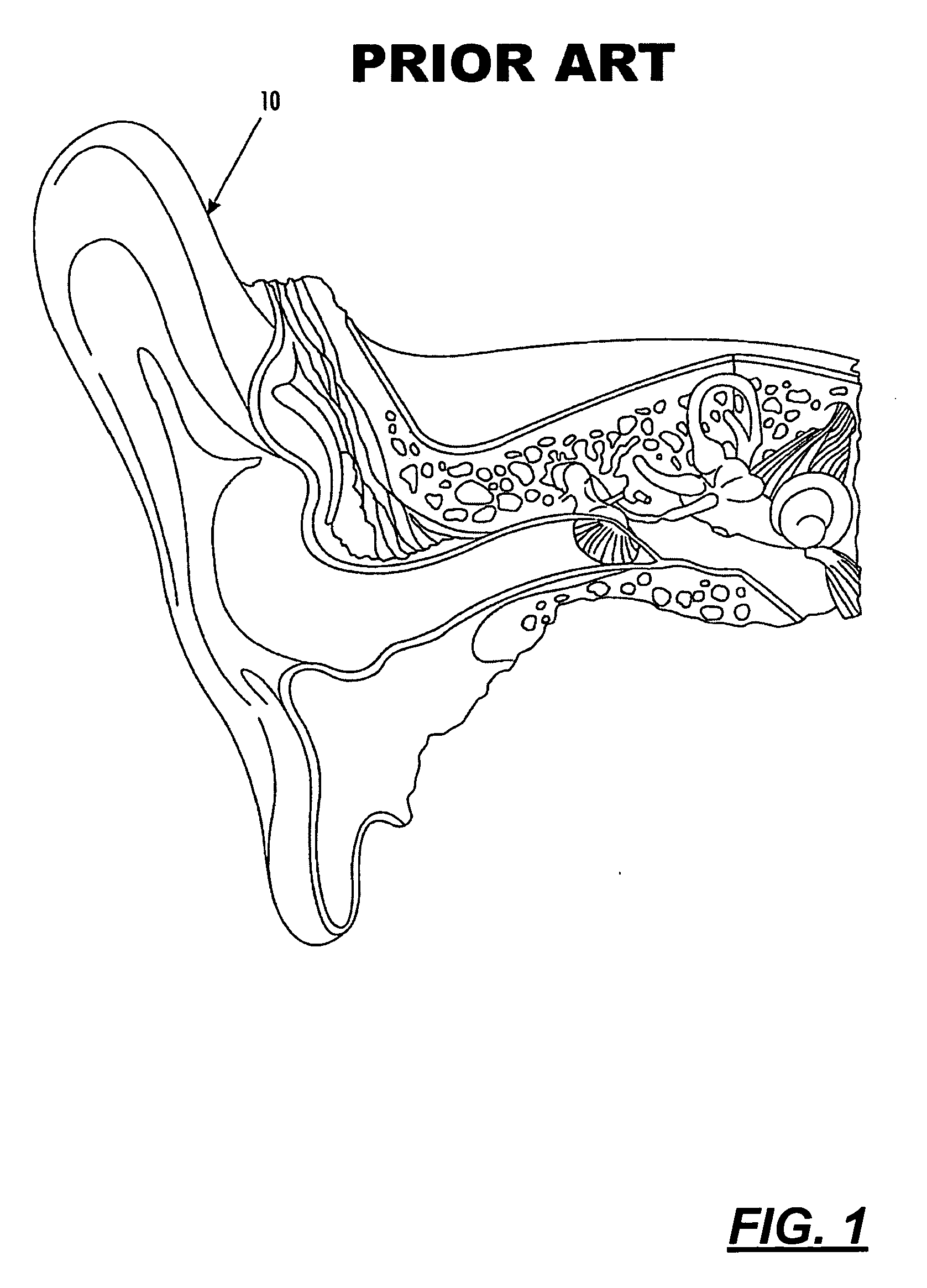 In the ear hearing aid utilizing annular acoustic seals