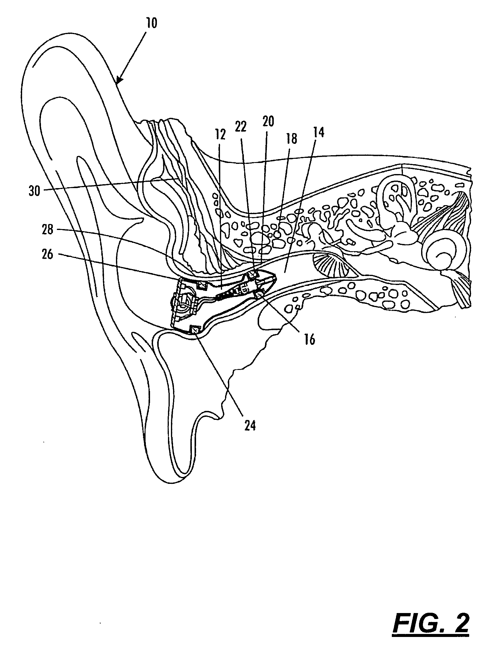 In the ear hearing aid utilizing annular acoustic seals