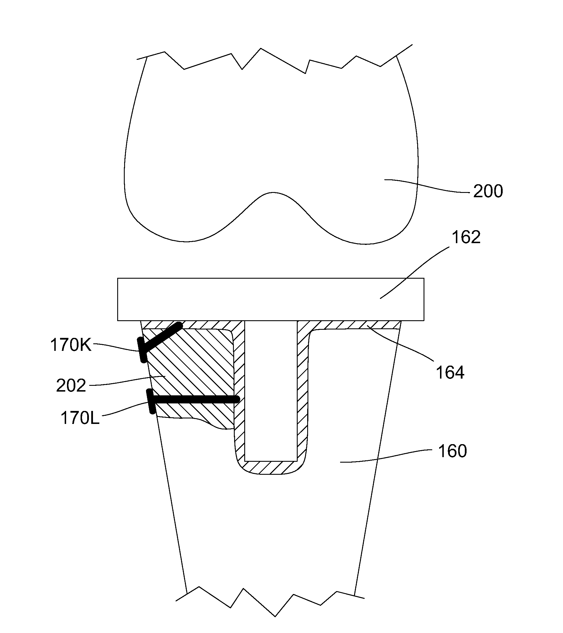 Methods and devices for utilizing bondable materials