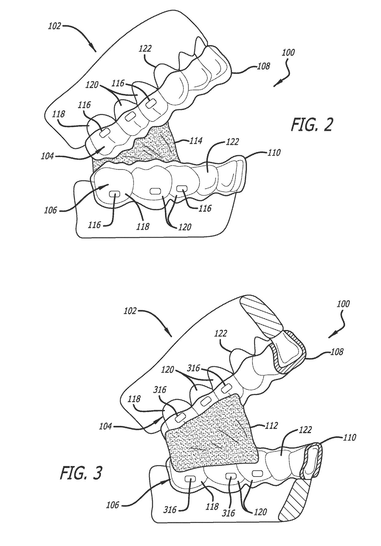 Oral weight control device