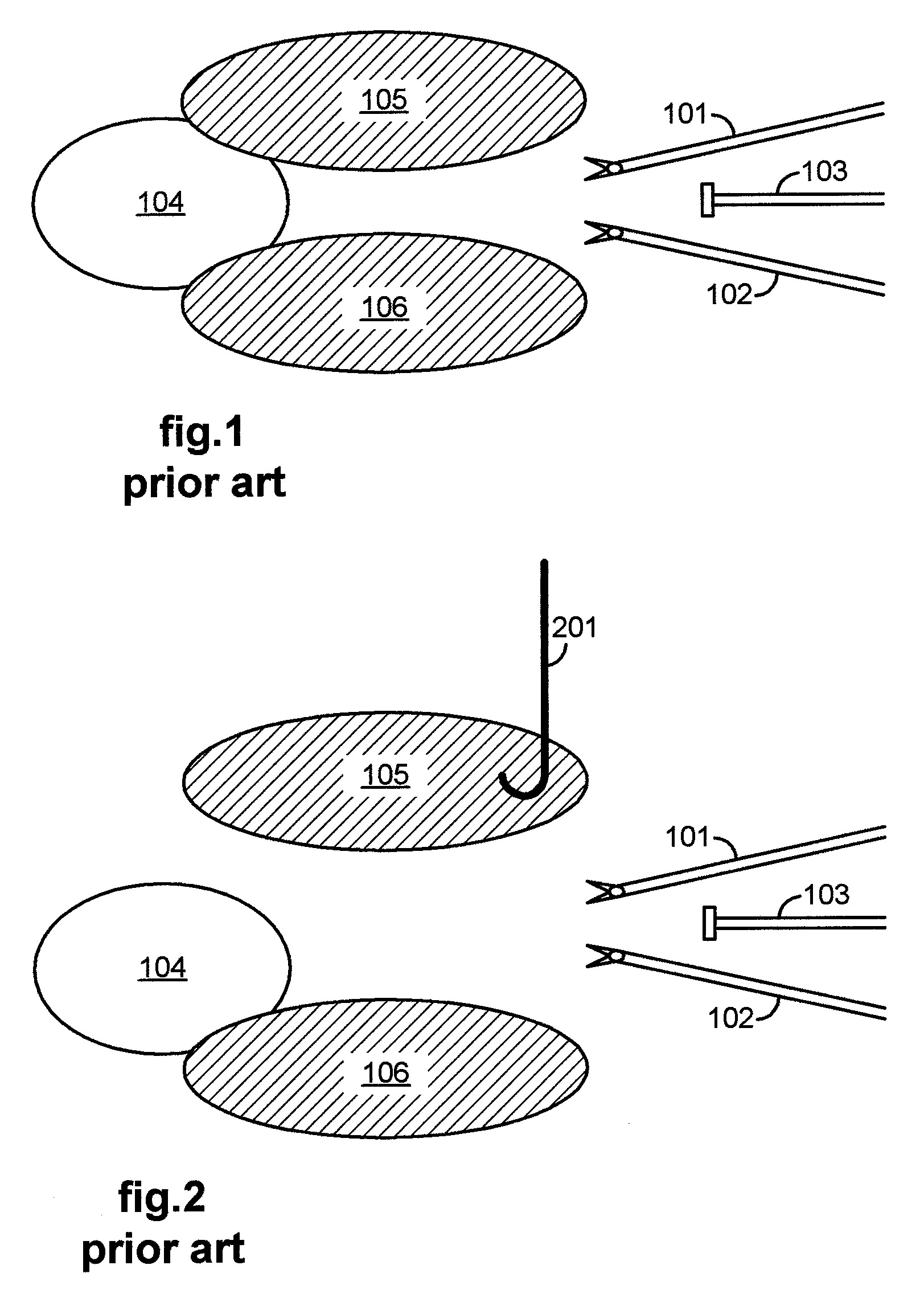 Retraction of tissue for single port entry, robotically assisted medical procedures