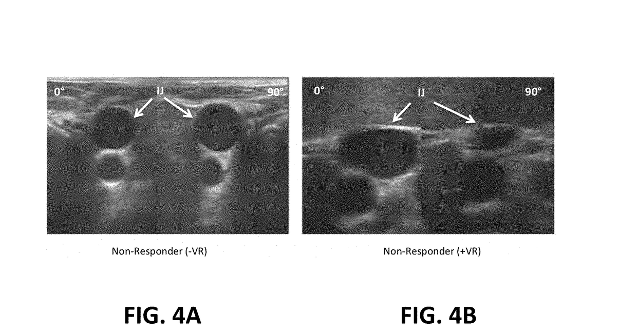 System and method for assessment of cardiac stroke volume and volume responsiveness