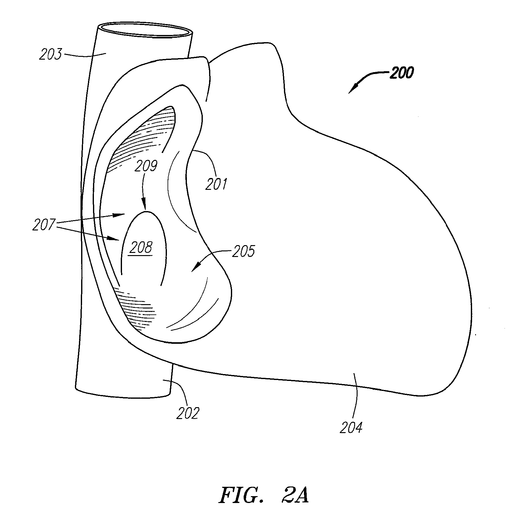 Clip-Based Systems and Methods for Treating Septal Defects
