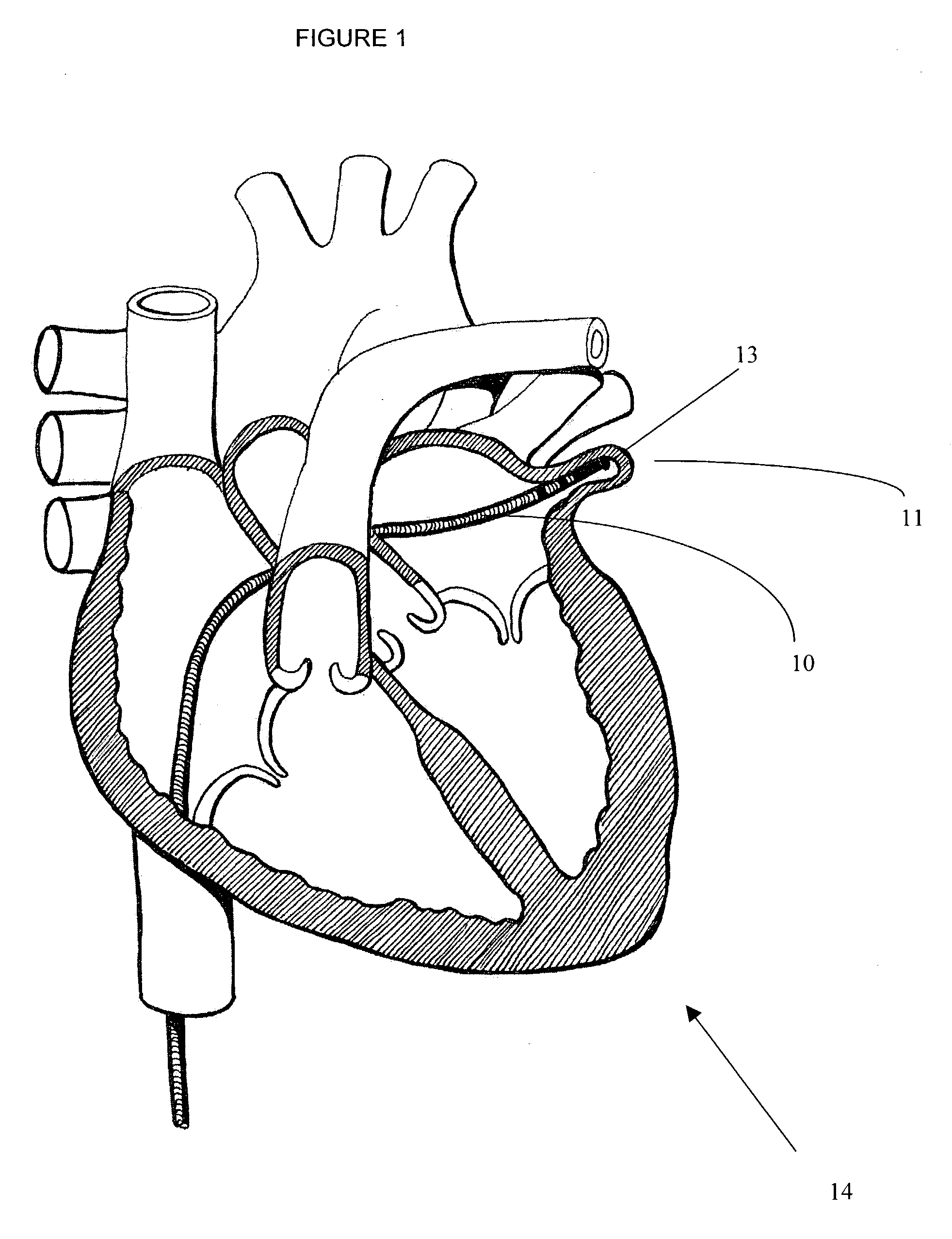 Methods and devices for modulating atrial configuration