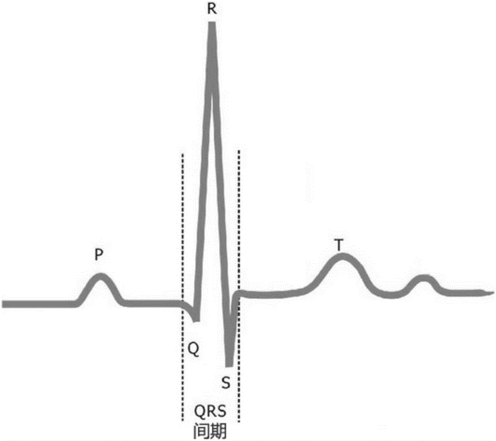 QRS-wave-group detection method