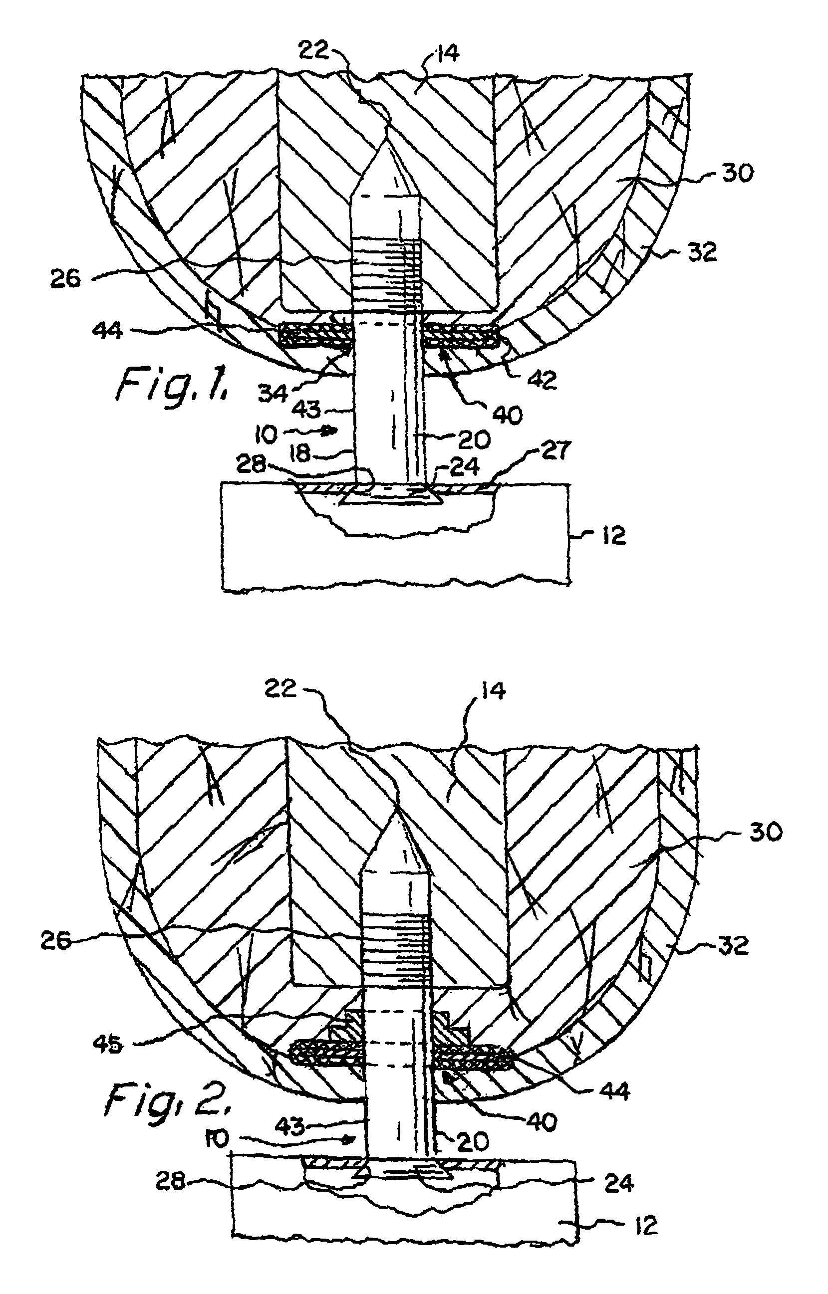 Prosthesis attachment method and apparatus with soft tissue integrating seal