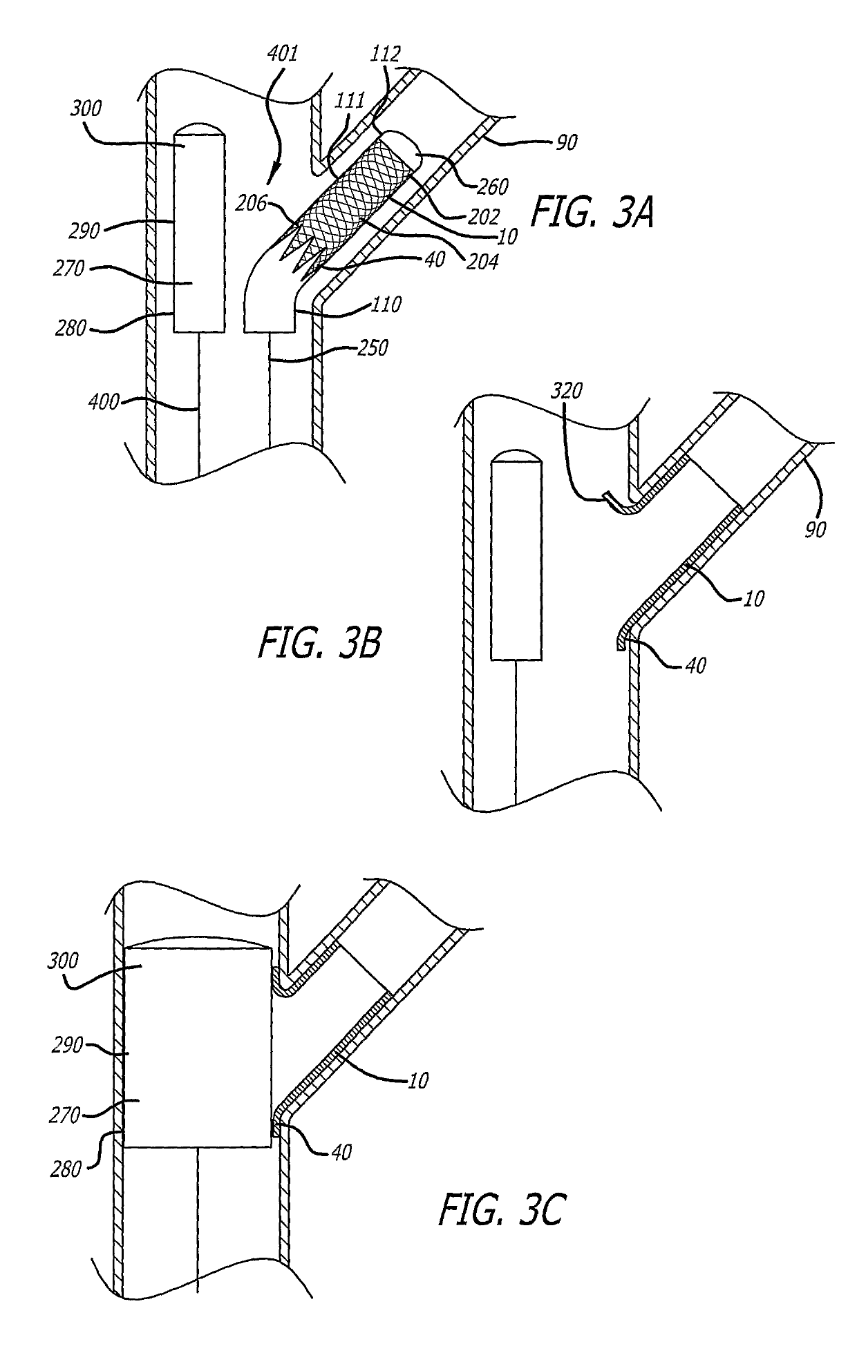 System and method for deploying a proximally-flaring stent