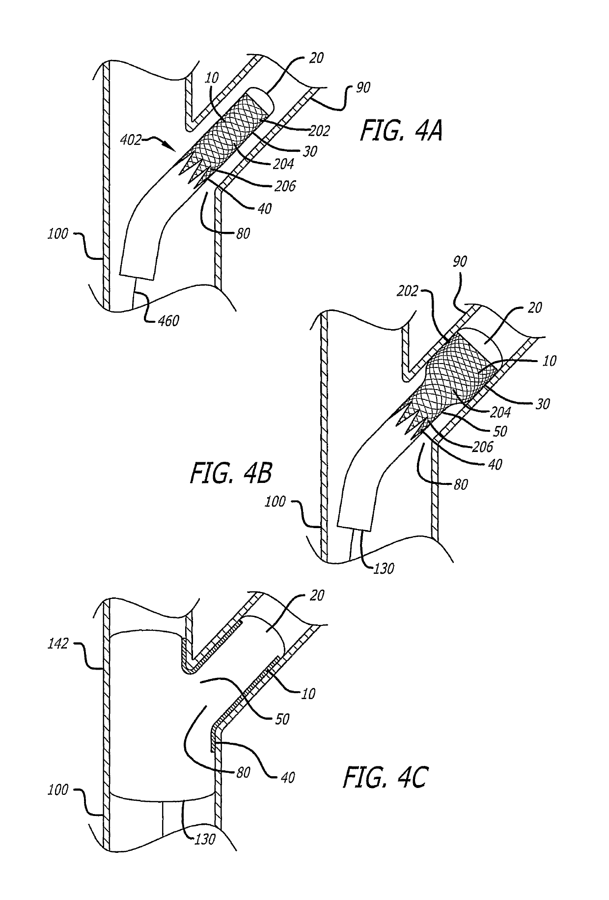 System and method for deploying a proximally-flaring stent