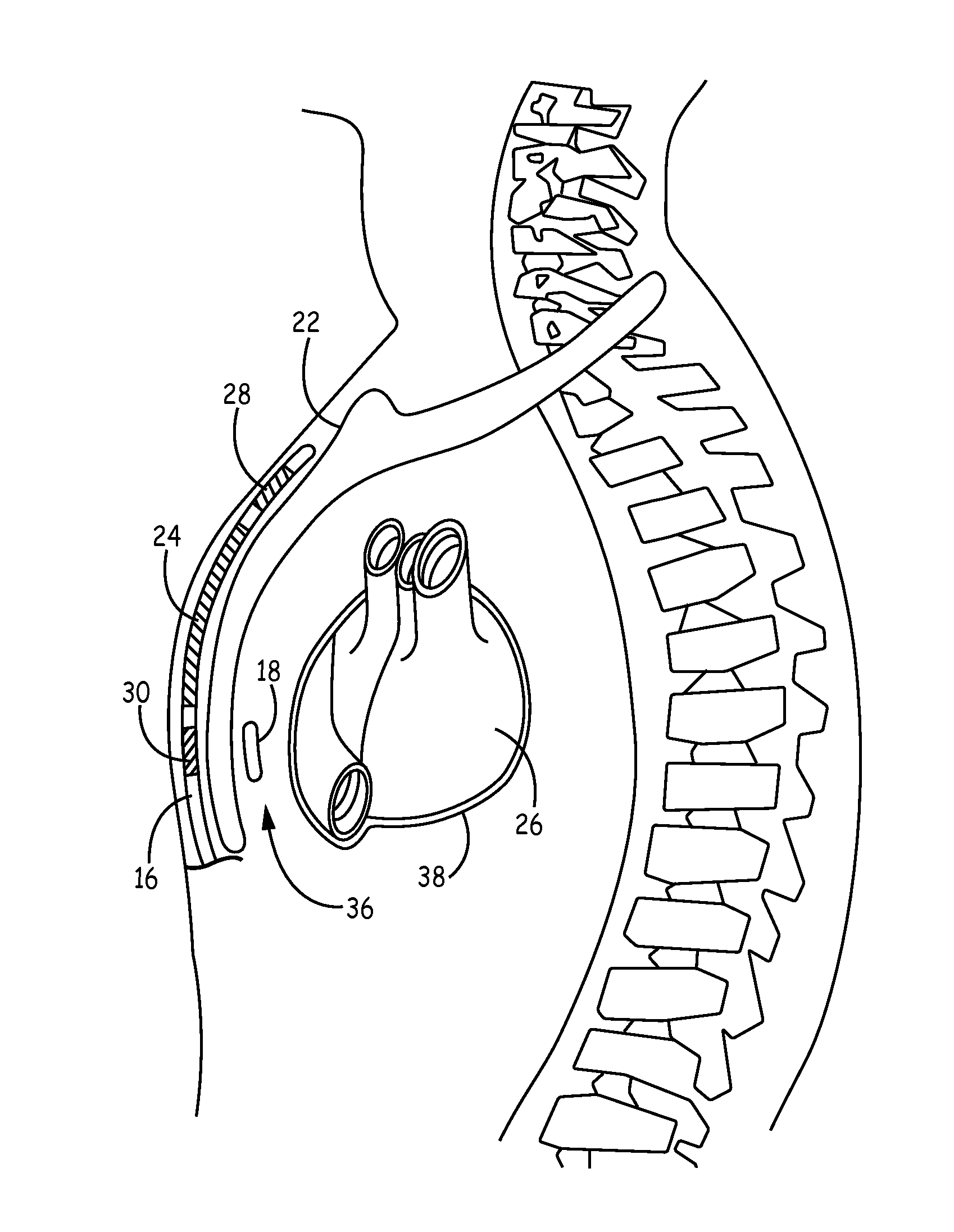 Implantable medical device system having implantable cardioverter-defibrillator (ICD) system and substernal leadless pacing device