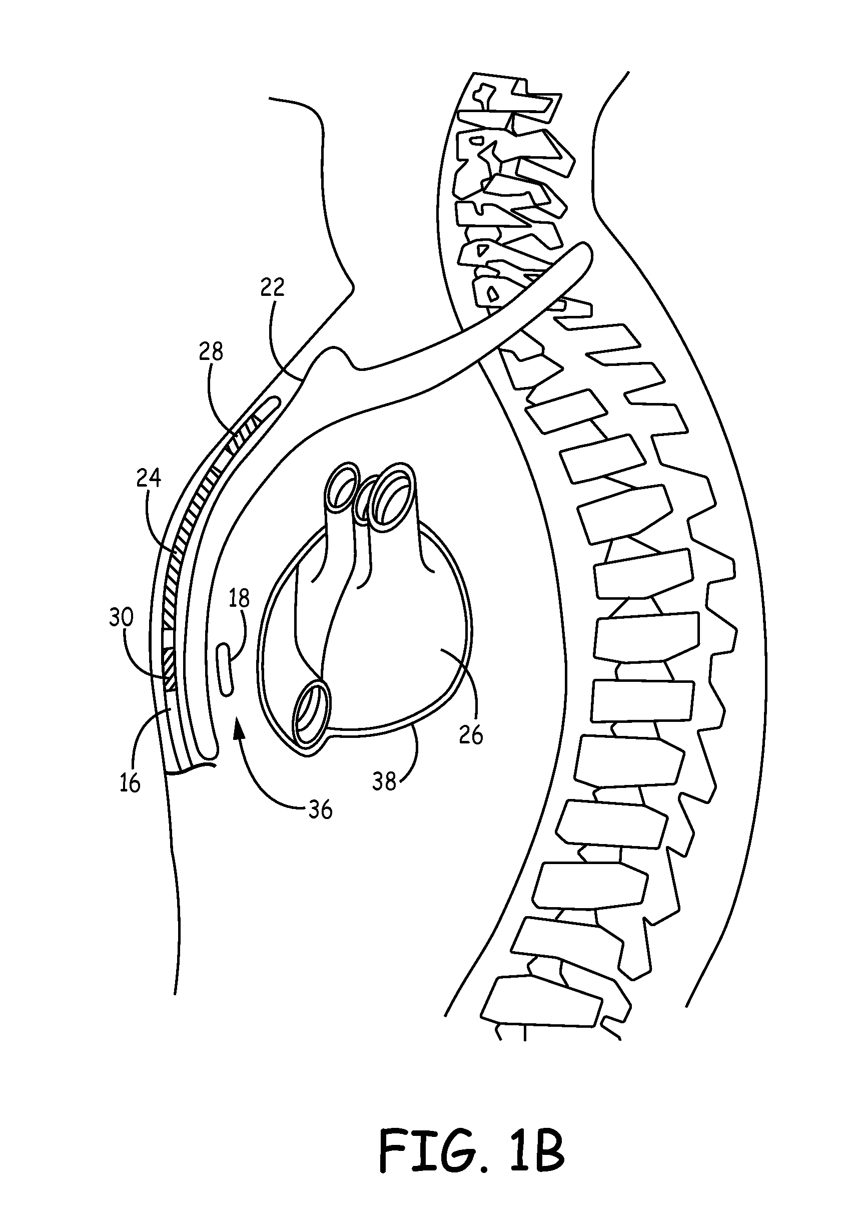 Implantable medical device system having implantable cardioverter-defibrillator (ICD) system and substernal leadless pacing device