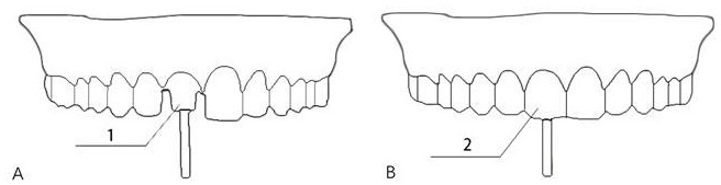 A method for reducing the formation of residual adhesive in the process of cement-retained implant repair