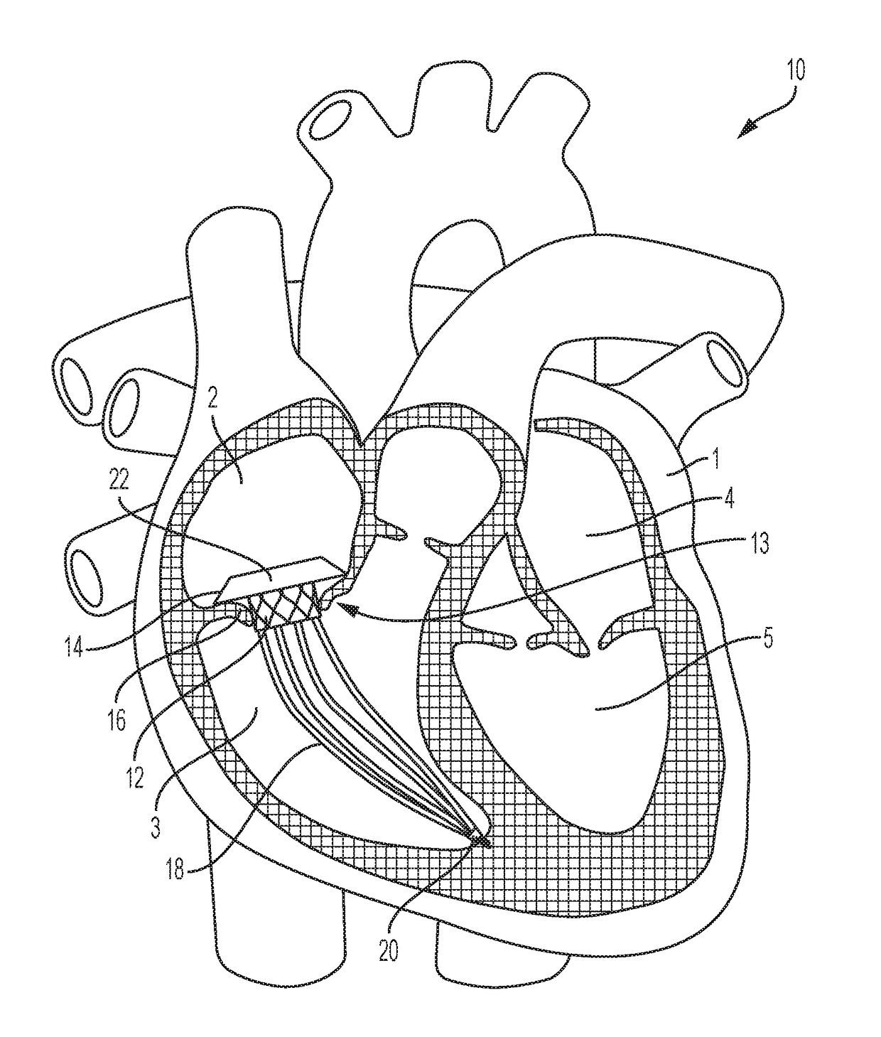 Transcatheter atrial sealing skirt, anchor, and tether and methods of implantation