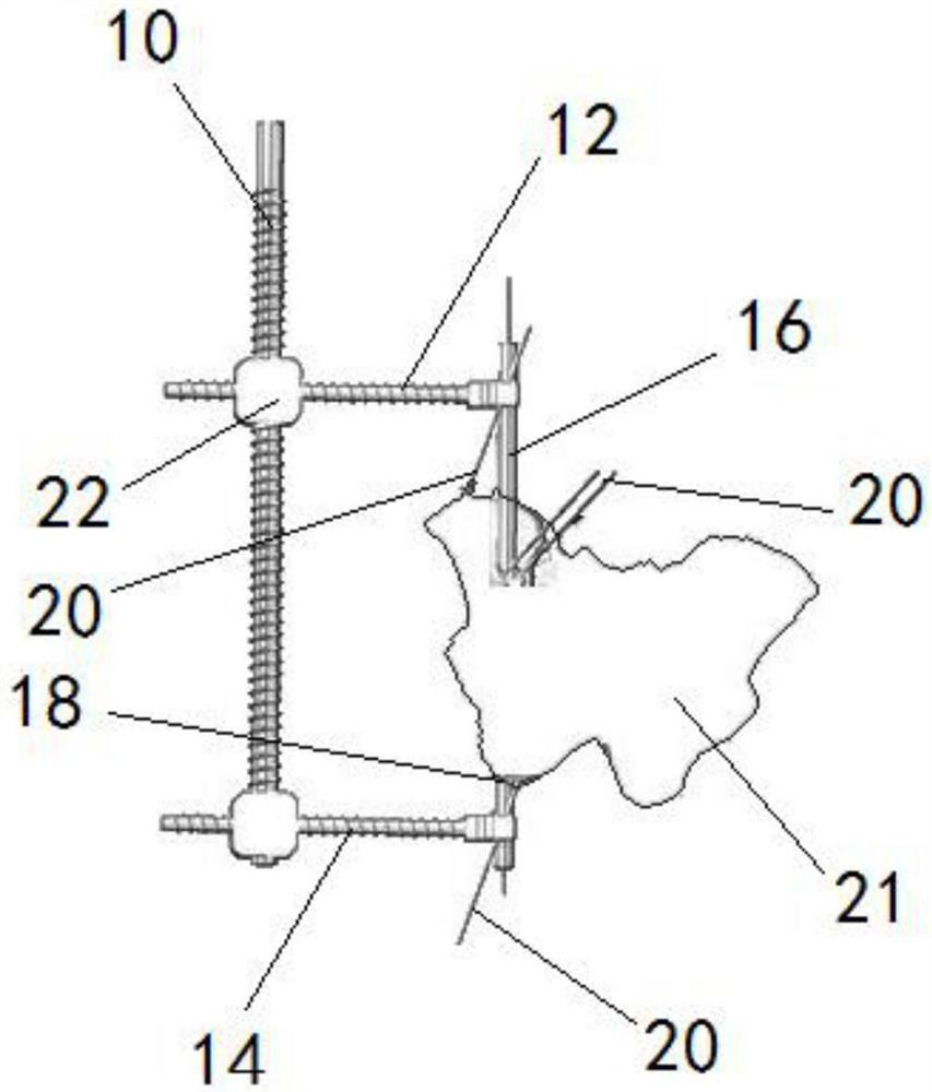 Acetabulum posterior column screw guider