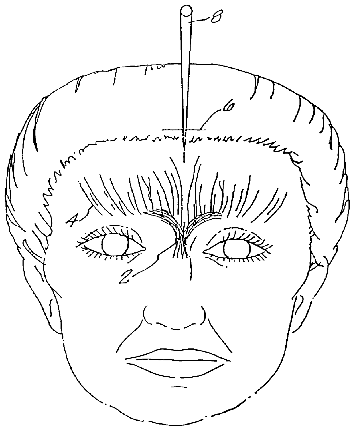 Method of laser cosmetic surgery