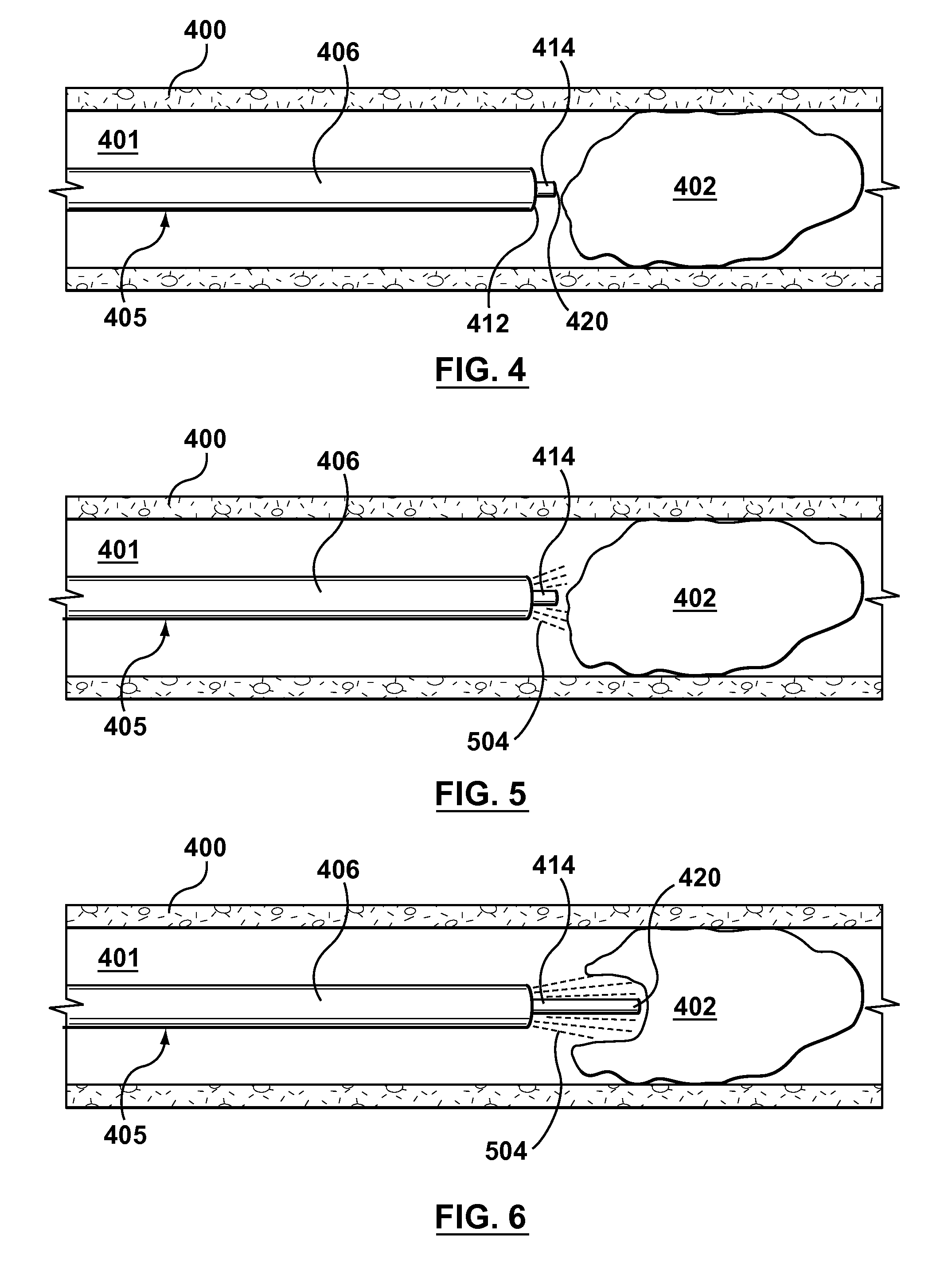 Apparatus and Methods for Recanalization of a Chronic Total Occlusion