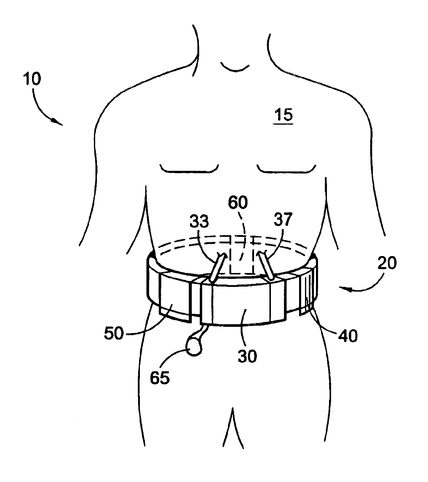 Wearable continuous renal replacement therapy device