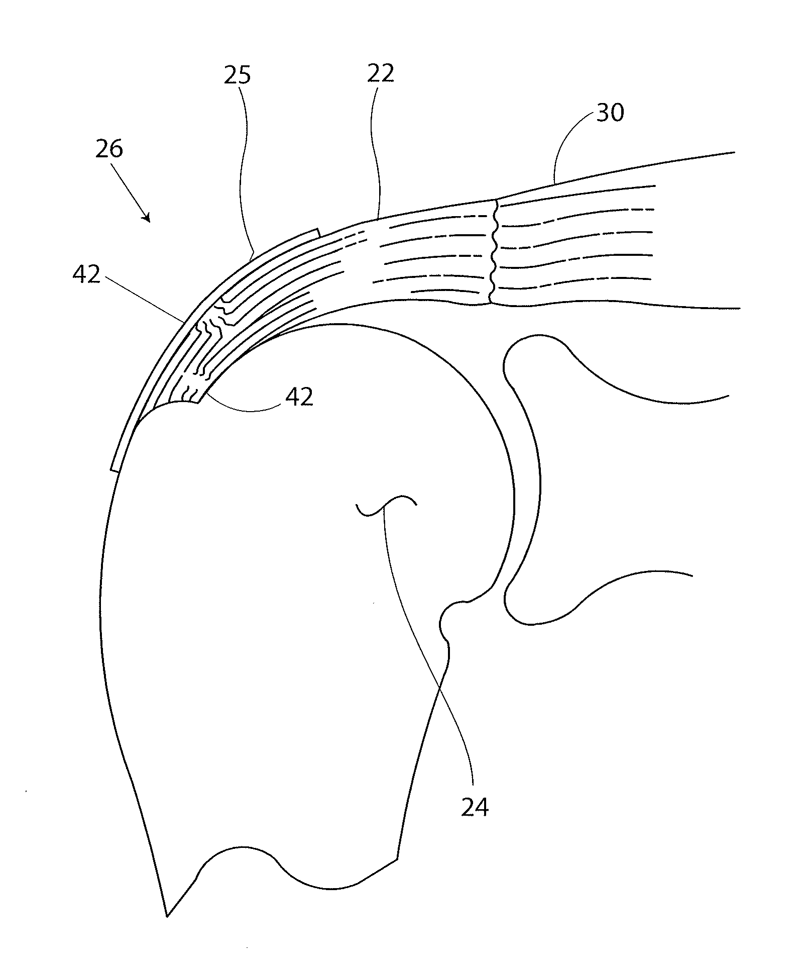 Tendon repair implant and method of arthroscopic implantation