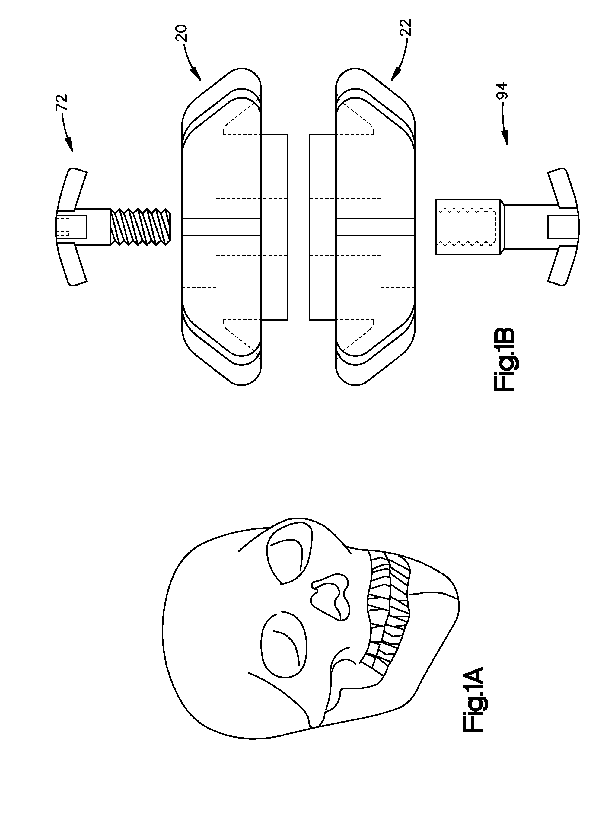 Method and apparatus for treatment of bones