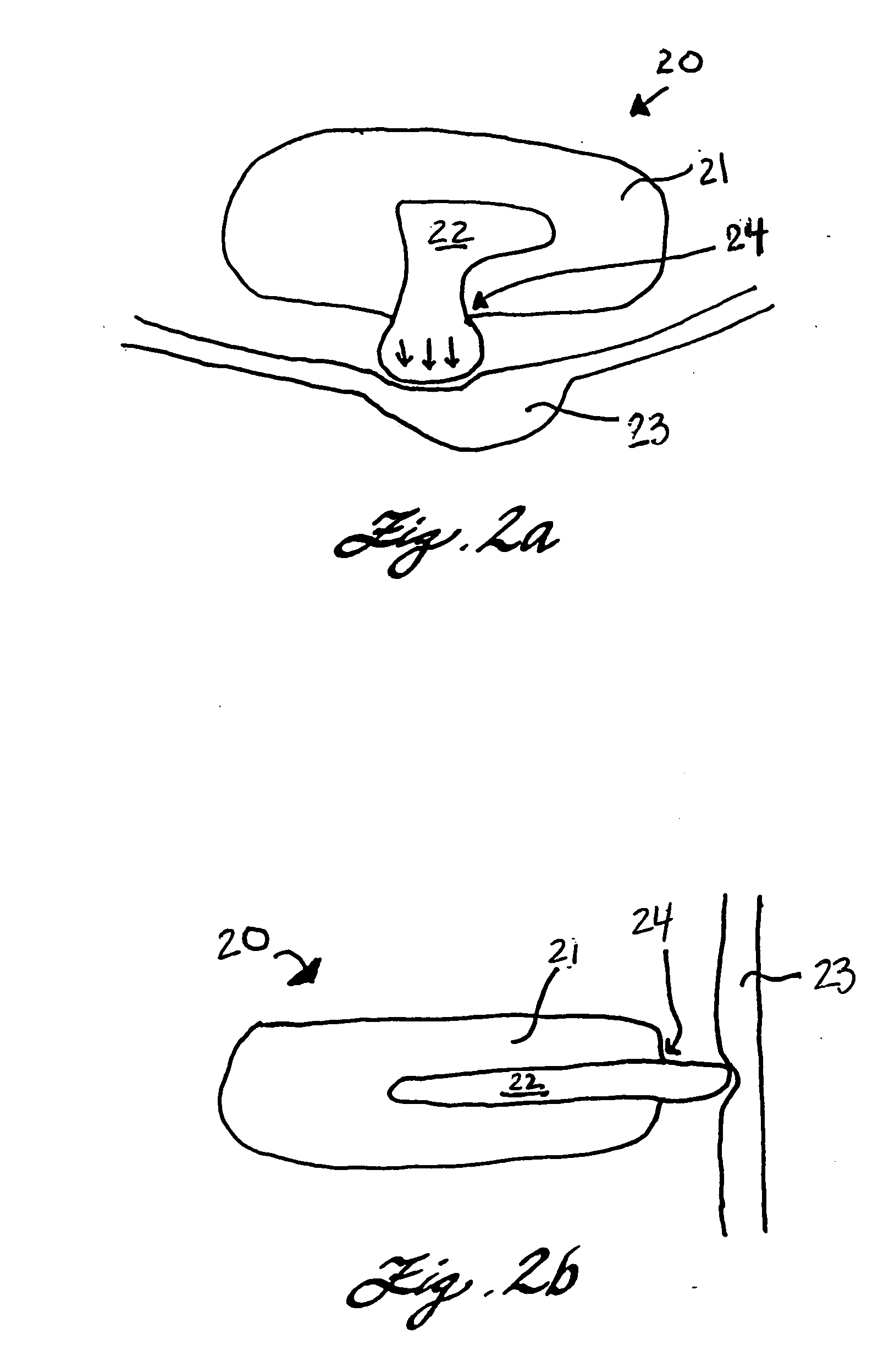Expandable implant for repairing a defect in a nucleus of an intervertebral disc