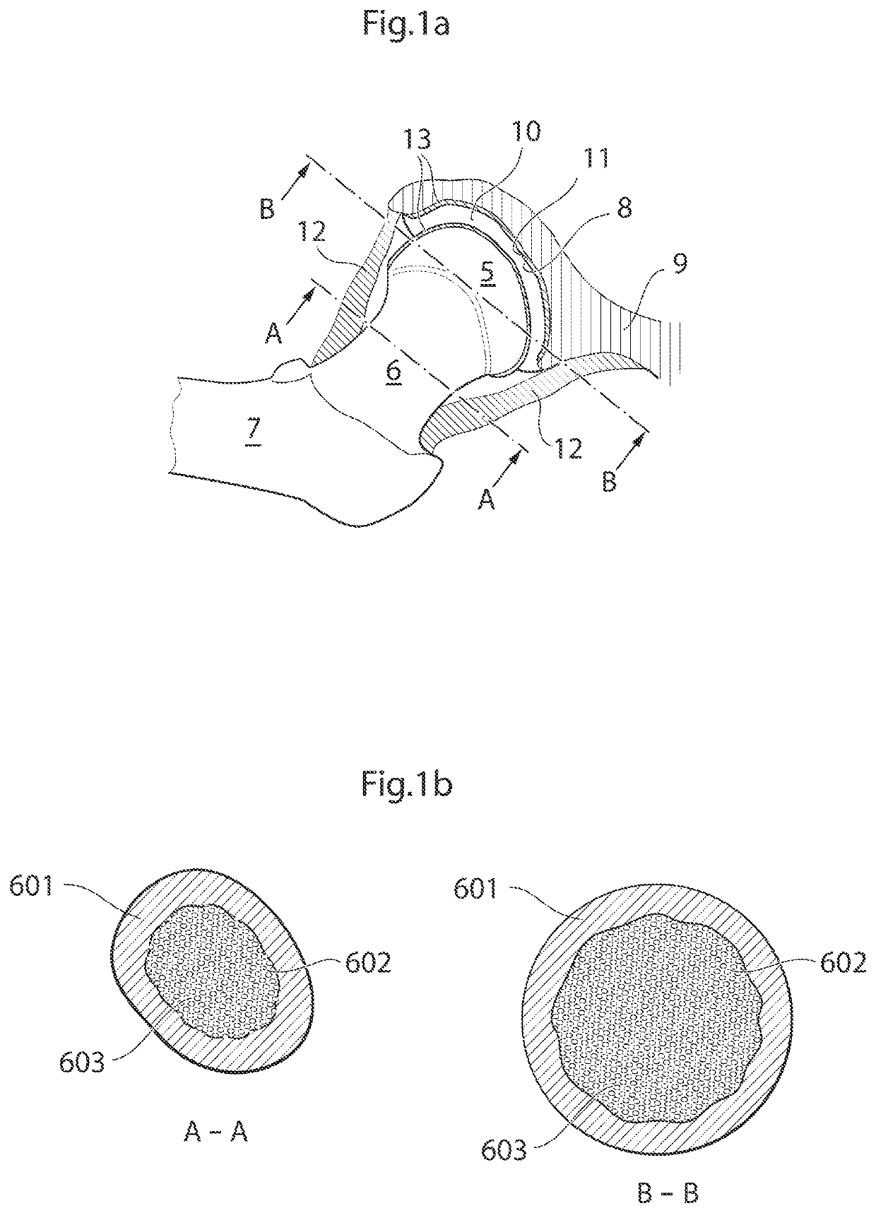 Hip joint device and method