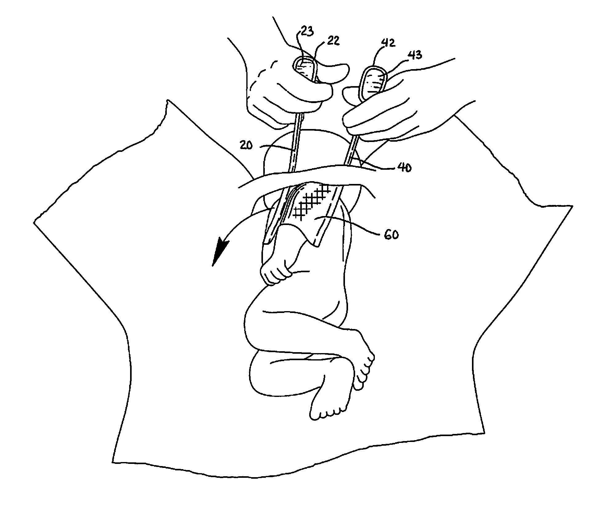 Device for treating shoulder dystocia