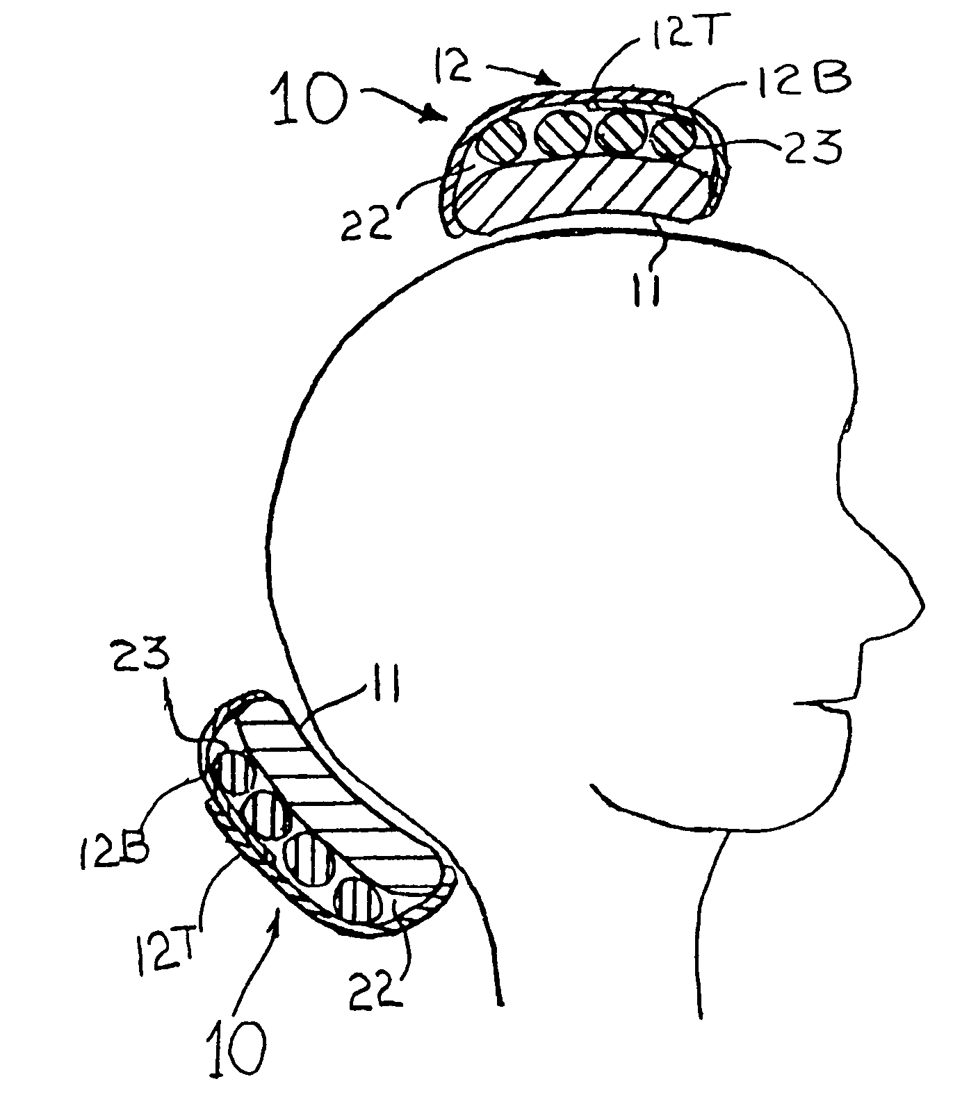 Means and methods for treating headaches