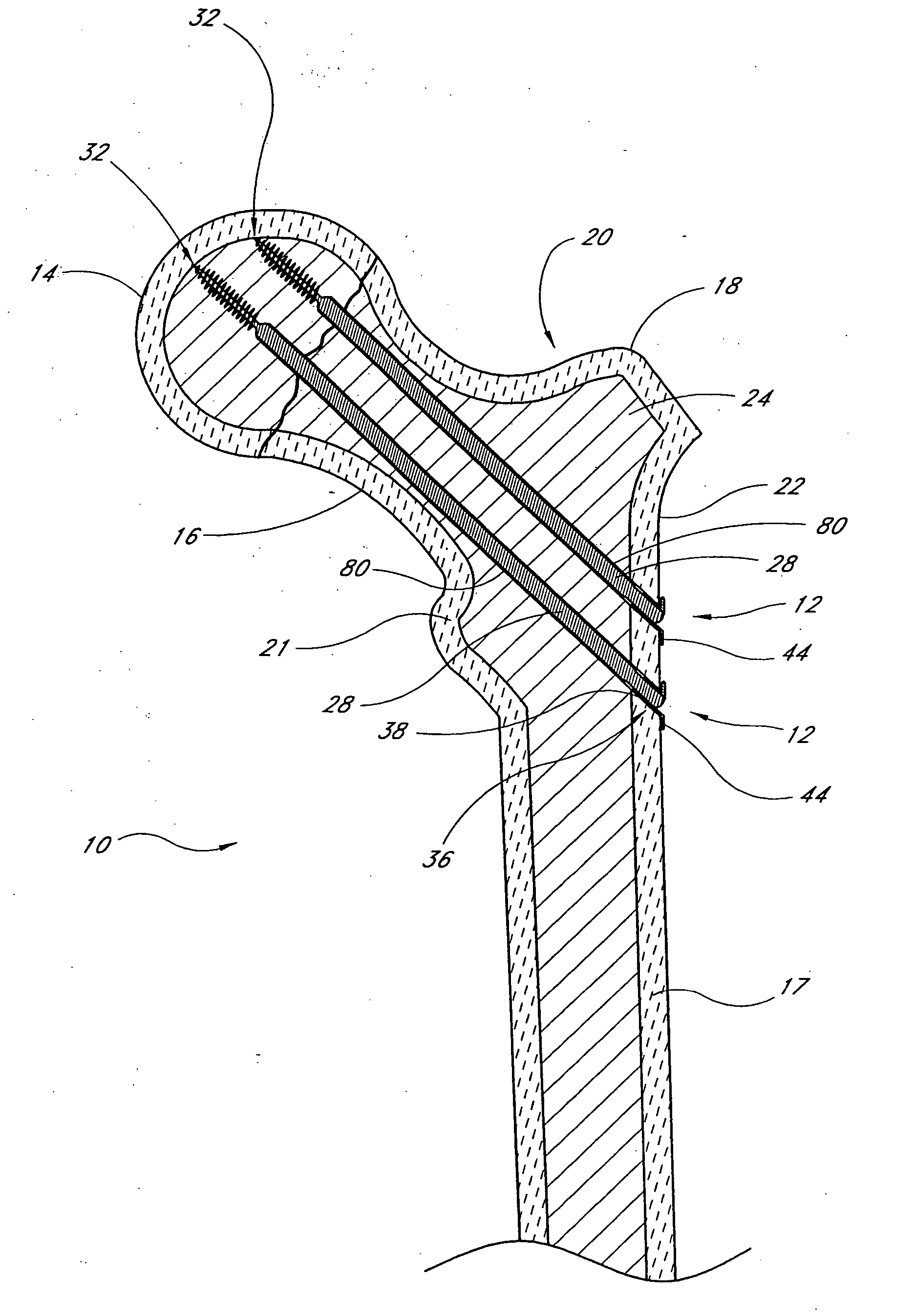 Method and apparatus for spinal fusion