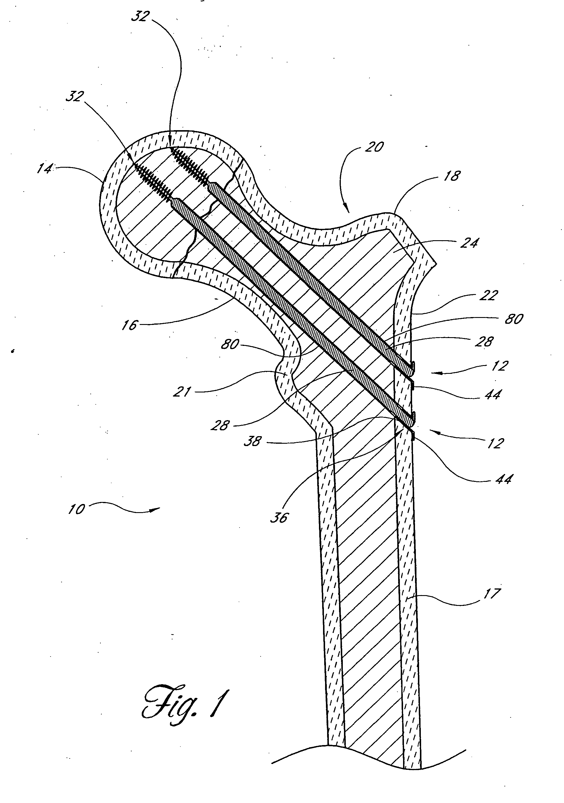 Method and apparatus for spinal fusion