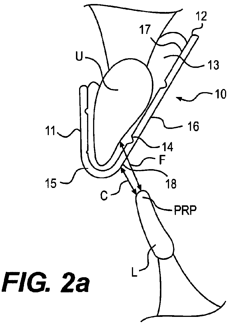 Intra-Oral Device and Method of Relieving Head, Neck, Facial, Joint and Tooth Pain