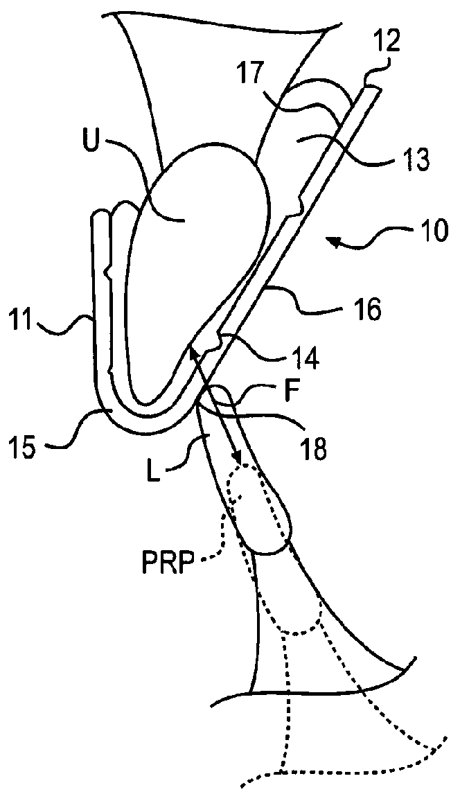 Intra-Oral Device and Method of Relieving Head, Neck, Facial, Joint and Tooth Pain