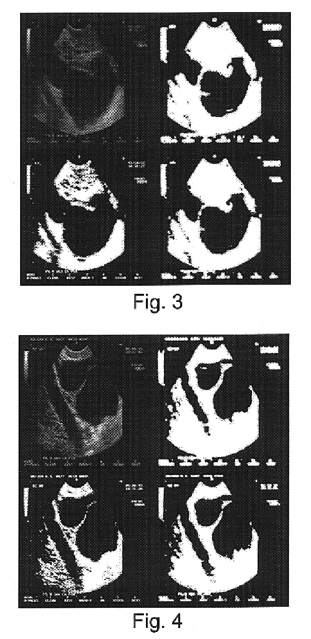 Method and system for automatic classification and quantitative evaluation of adnexal masses based on a cross-sectional or projectional images of the adnex