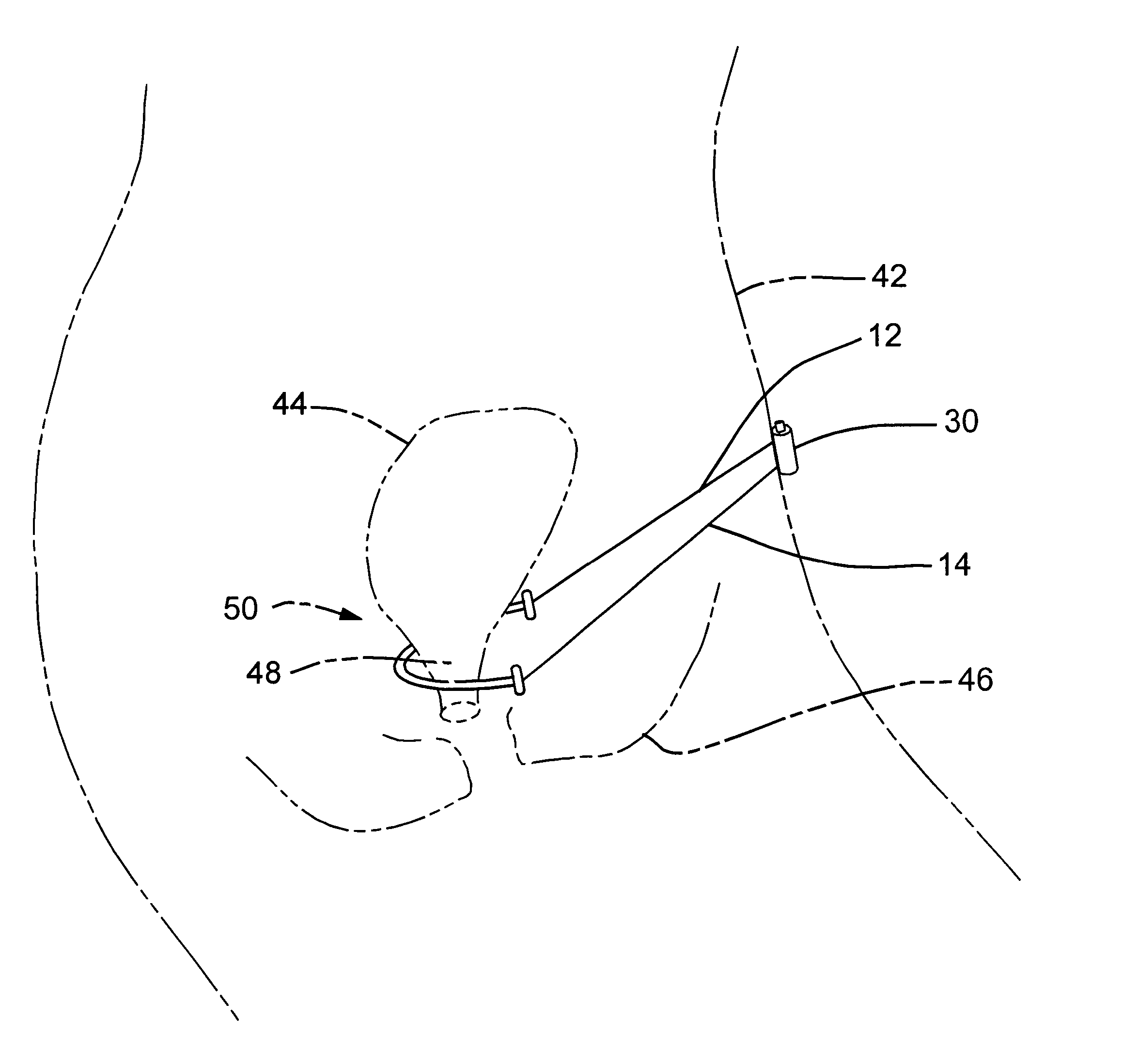 Absorbable pubovaginal sling system and method