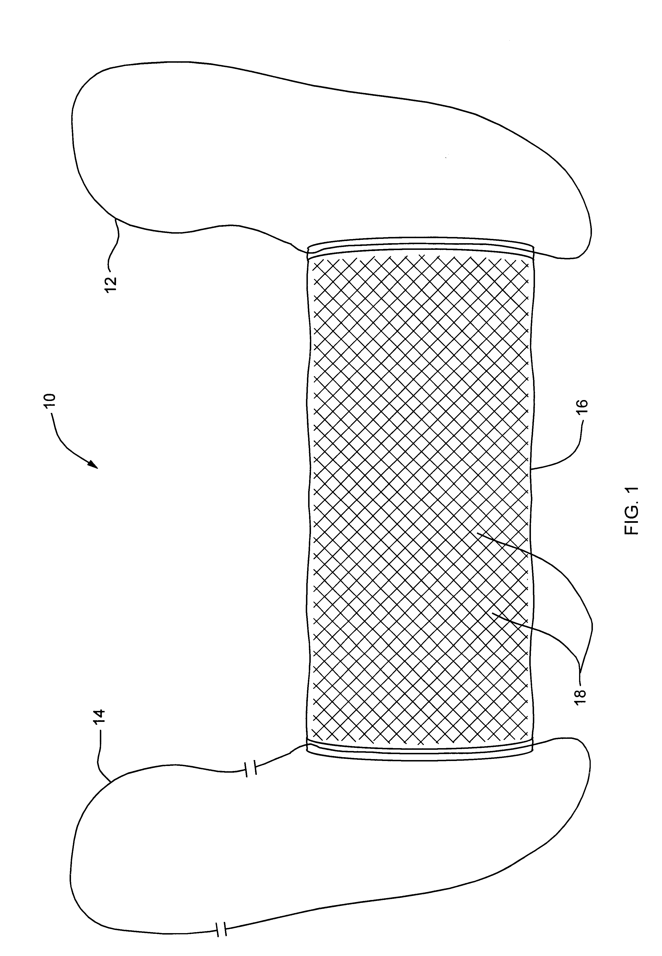 Absorbable pubovaginal sling system and method