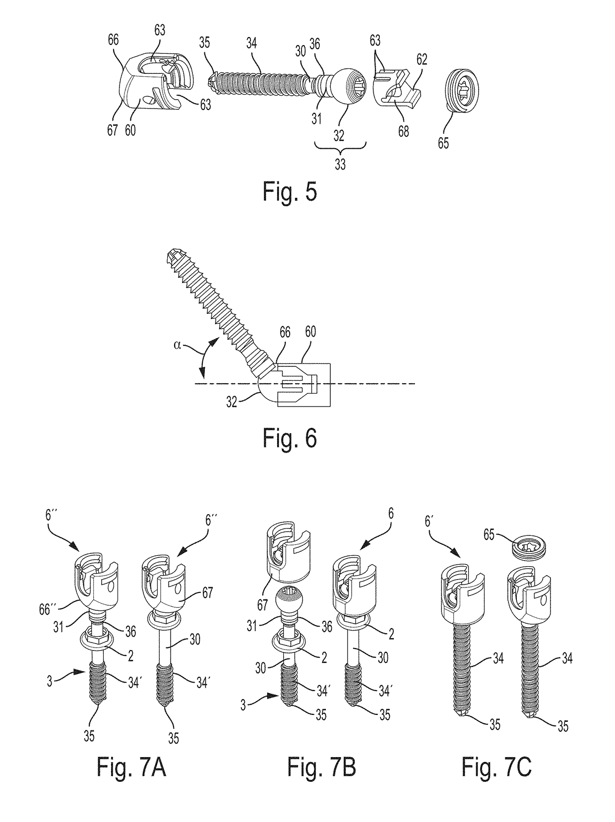 Spinal multi-level intersegmental stabilization system and method for implanting
