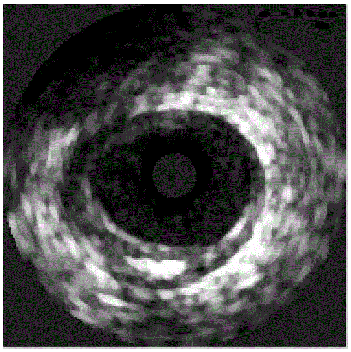 An Intravascular Ultrasound Image Segmentation Method