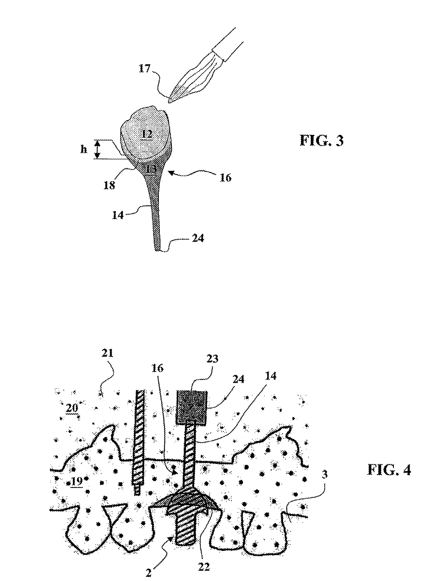 Ceramic dental prosthesis, method and device for making same