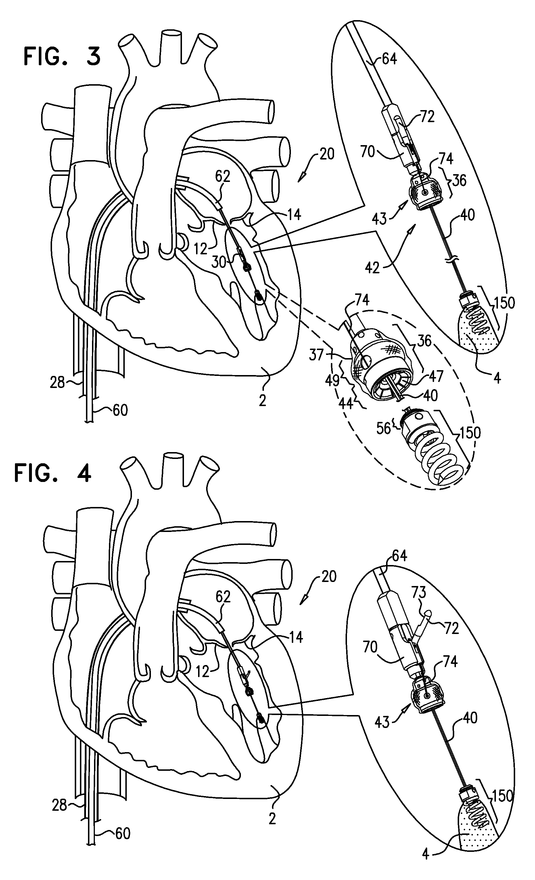 Apparatus and method for guide-wire based advancement of an adjustable implant